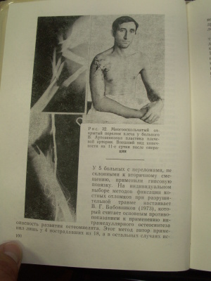 Захарова Г.Н., Р.З. Лосев, Гаврилов В.А. Лечение повреждений магистральных сосудов конечностей